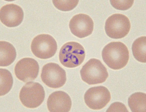 Red Blood Cell Pathology